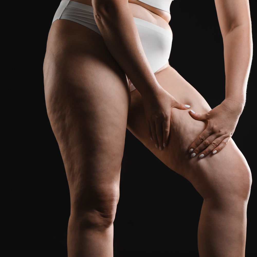 Lipedema: 3 consigli fondamentali per affrontare al meglio il periodo caldo